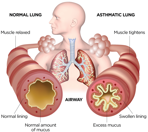 normal-vs-asthma-lung